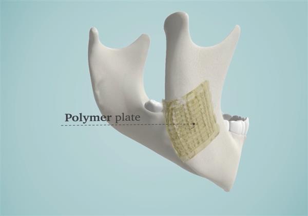 解决医生烦恼 3D打印生物陶瓷修复骨骼
生物陶瓷,3D打印生物陶瓷,工业3d打印机,3D打印机价格,3D打印服务,3D打印技术,中国3d打印技术,上海3D打印,北京3D打印