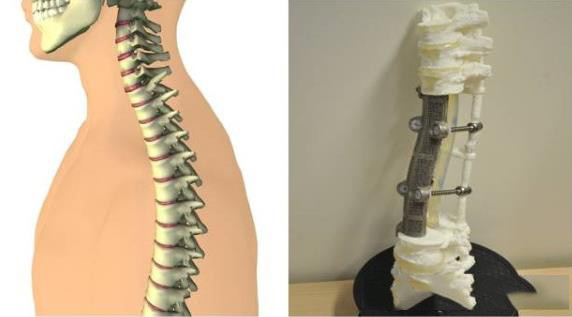 3D打印医疗应用成功案例 北医三院3D打印定制人工椎体植入术