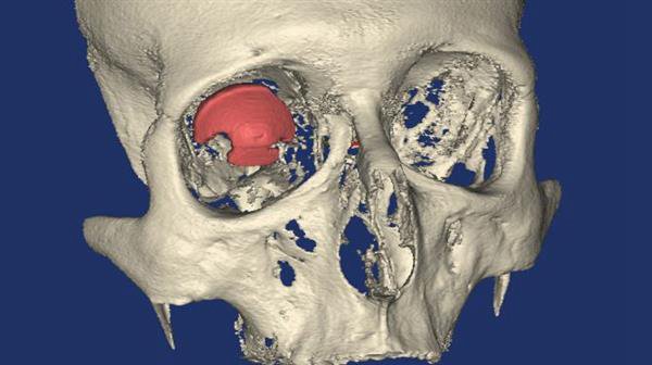 3D打印技术在医疗方面的应用 世界首个3D打印义眼_E键3D打印服务 3D打印技术在医疗方面的应用 世界首个3D打印义眼_E键3D打印服务