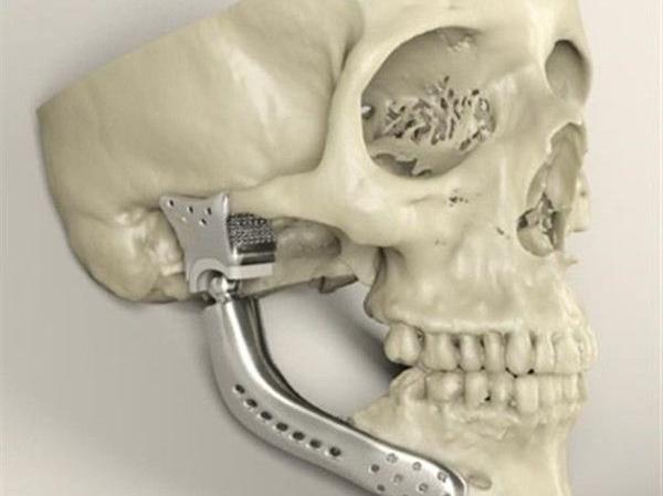 简述3D打印技术在医疗行业应用情况_e键3D打印服务 简述3D打印技术在医疗行业应用情况_e键3D打印服务