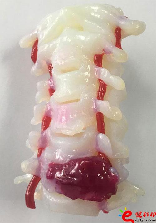 3D打印颈椎肿瘤