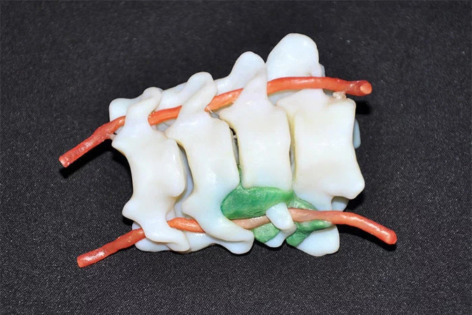 全彩3D打印颈椎骨科模型