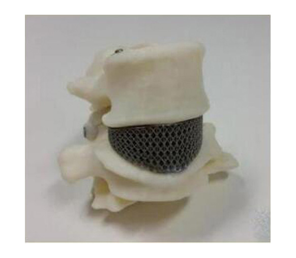 腰椎金属植入物1