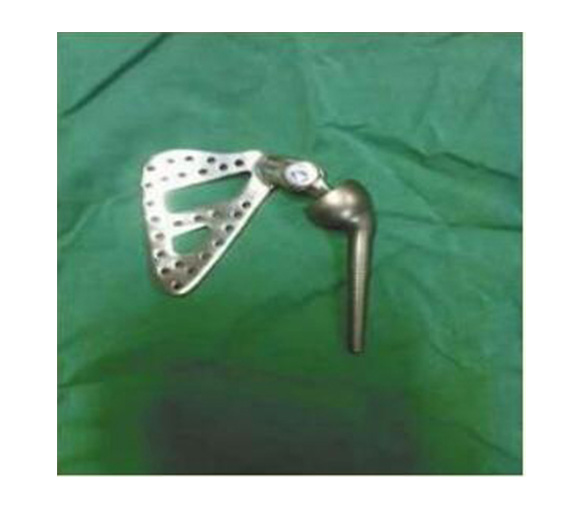 肩关节金属植入物1