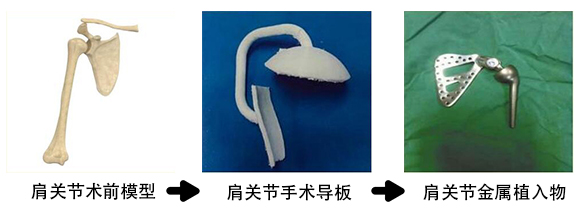 肩关节金属植入物2