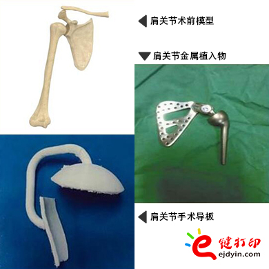 肩关节金属植入物