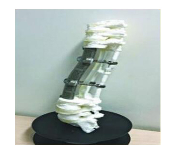 脊椎金属植入物1